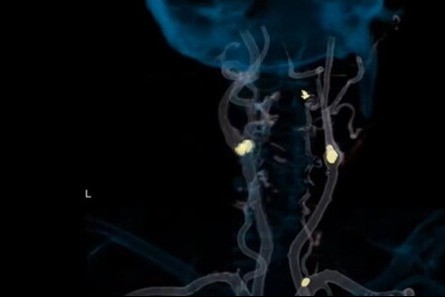 carotid12.jpg