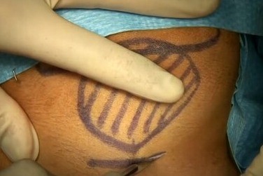 cyst2.jpg