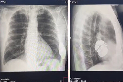 defibrilator_1.jpg